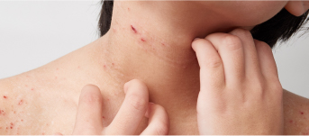 アトピー性皮膚炎