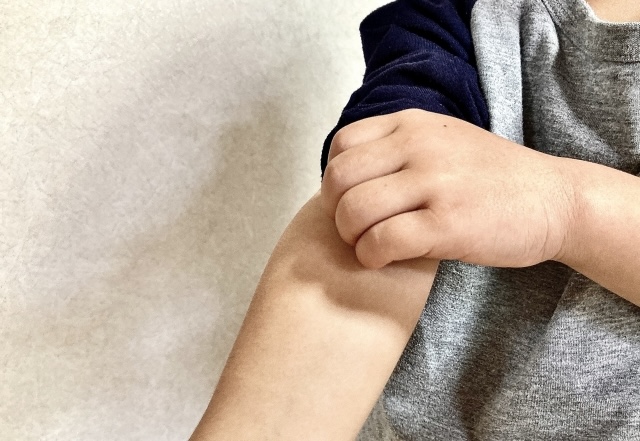 アトピー性皮膚炎とは？